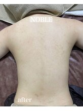 ノーブル 新宿南口(NOBLE)/背中リベルハーブピーリング
