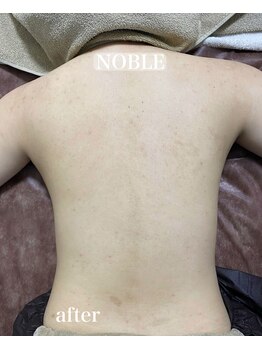 ノーブル 新宿南口(NOBLE)/背中リベルハーブピーリング