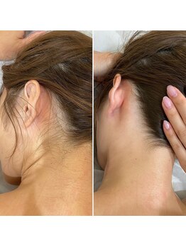 インベスト(INVEST)/うなじ脱毛