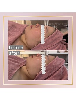 ベルメール(Bellemer)/FOREVERYOUNGのビフォーアフター