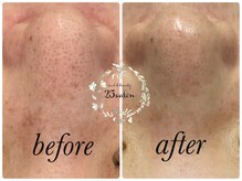 ニコサロン(25salon)/ハイドラフェイシャル