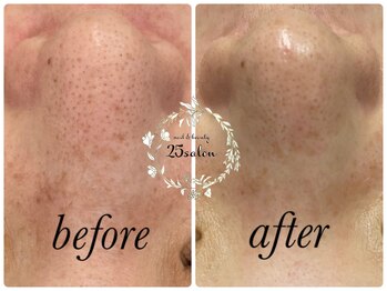 ニコサロン(25salon)/ハイドラフェイシャル