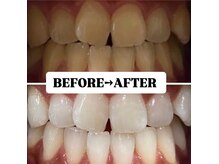 ホワイトニングサロン 豊中/Before&After美白ホワイトニング