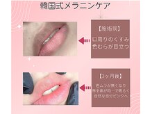 新メニュー"ドールピンク"VIO・乳輪など脱毛後の黒ずみケアに◎