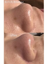 ヨルエステ(yoru aesthe)/【毛穴洗浄、全顔】