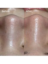 ミルタンドレス(Mille Tendresses)/毛穴洗浄＋部分フェイスワックス