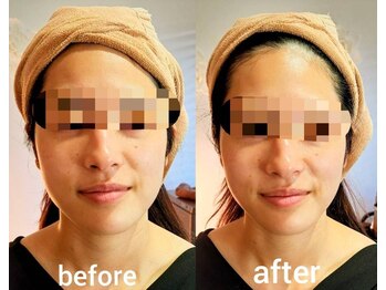 リノブルーム(LINO Bloom)/高周波マシン サーマトリックス