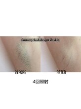 ファウラ(faura:)/ワキ脱毛