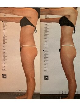 ビューティースパ/お尻・お腹ボリュームダウン