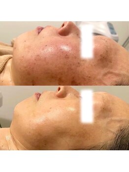 エヌーサ(Enoosa)/★大人気のER200インディバ★