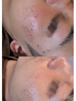 サロンドポノ(Salon de Pono)/肌質改善コース