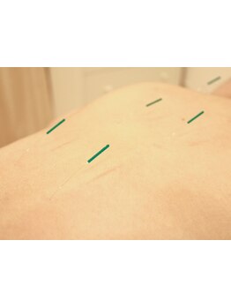 鍼灸施術を受けたい