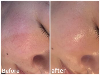 ボヌールデソワ(Bonheur de Soi)/ハーブピーリング/赤ら顔/北堀江