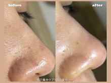 リンデザ(LINDEZA)/黒ずみ撃退！１回でも変化実感！