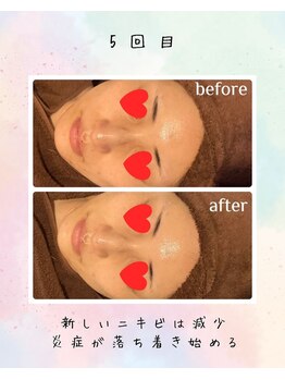 リリアン(lirien)/毛穴/毛穴ケア/毛穴洗浄/駒込