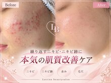 ラティーナ(Lattina)の雰囲気（【ニキビ／ハーブピーリング】ニキビ／毛穴細胞美容☆肌質改善）