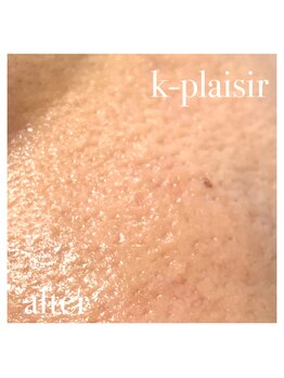 ケイ プレジール/ディープハイドラホワイトafter