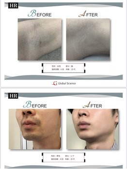 サンバイエム(#3/M)/セルフ脱毛