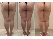 スローティ ラテ 札幌ピヴォ店/キャビテーション