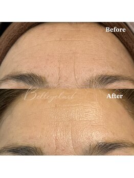 ベルアイラッシュ(Belleyelash)/【フェイシャルワックス】