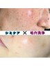 《セットでお得》シミケア20分し放題＋毛穴洗浄