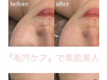 ボディベルム(BODY BELM)/毛穴汚れ