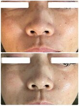 ビジュープラス 幸手店(Bijou+)/シワ・毛穴ケア