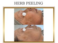 ロージー(ROSY)/ハーブピーリング/阿南/徳島