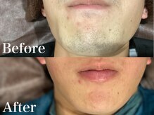 ボス 岡崎店(BOSS)/【顔脱毛/ヒゲ脱毛】首　#脱毛