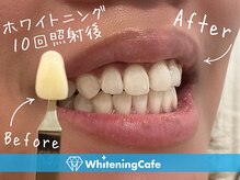 ホワイトニングカフェ 志木店/ホワイトニングビフォーアフター