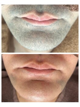 アカラ 読谷店(AKALA)/ヒゲ脱毛3か月経過