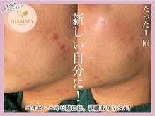 アッシュ 梅田(H)/ハーブピーリング専門Hアッシュ