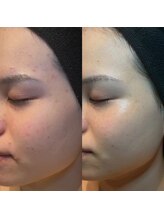 エラ(ella)/20代ニキビケア・色素沈着