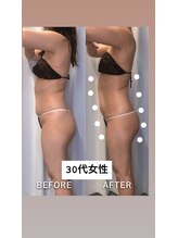 レチカ(Rechica)/吸い上げ（吸引）＋キャビ