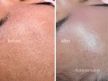 レネットサロン(Reinette Salon)の雰囲気（フェイシャルワックス×ハイドロジェリーマスク ¥8,800）