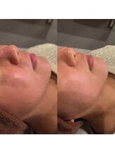 エクリア(ECLIA)/RED SHOT/脂肪分解