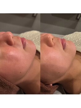 エクリア(ECLIA)/RED SHOT/脂肪分解