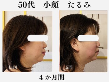 ランティル(l’until)の写真/年齢を重ねて小顔を目指す方に！レッドショットで理想のラインへ導くケア♪