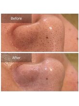 オーノ(Ohno)/[産毛脱毛]オーガニックWAX脱毛