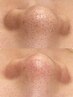 気になるお顔の部分Wax脱毛【藤原限定クーポン】3000円→2000円(1回のみ）