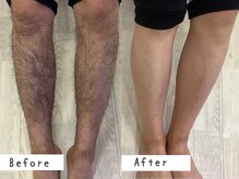 セルフメイド 高崎店(SELFMADE)/足脱毛10回ビフォーアフター