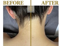 ヴェールブランシュ 町田(Vert Blanche)/#ブライダルエステ#シェービング