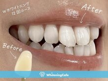 ホワイトニングカフェ 高松丸亀町グリーン店(WhiteningCafe)/◎歯のホワイトニング施術写真◎