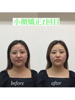 オズ六本木/小顔矯正モニター様(1回目)