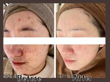 ハル(HARU.)の雰囲気（ハーブピーリング１２回で別人級のお肌に！）