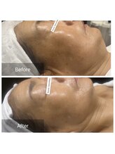 シン(Shin)/新メニューダクトピール