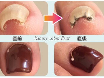 ビューティーサロンフルール(fleur)/巻き爪矯正¥3,850