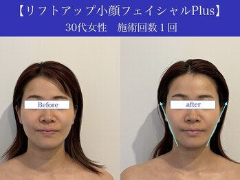 リプロ(RePro)/30代 ビフォーアフター