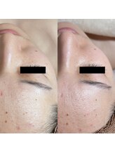 ネオオアシス トウキョウ(ネオOASIS TOKYO)/ハーブピーリング（剥離あり）