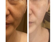 アドビューティ(Add Beauty)/≪たるみ改善／RFリフティング≫